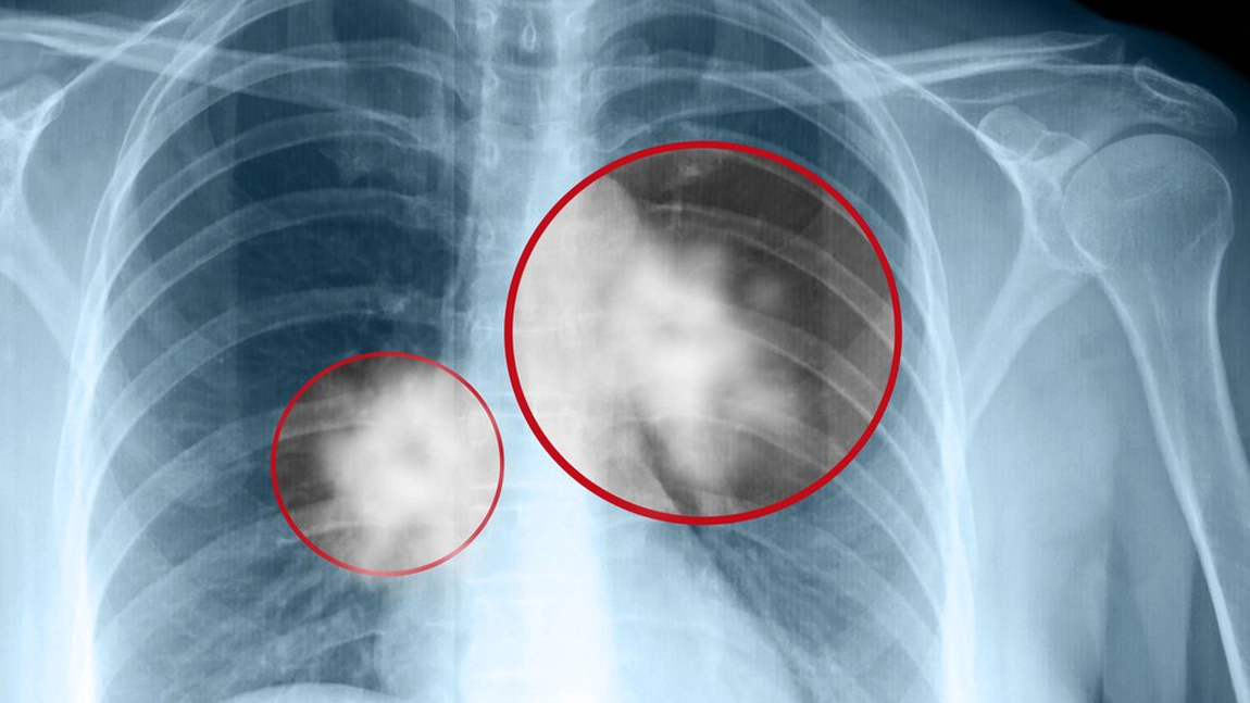 Cancer pulmonar: simptome și persoane cu risc