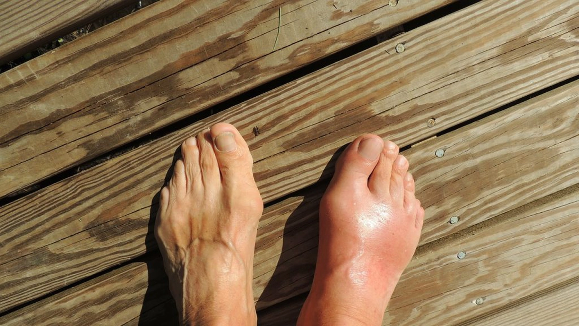 O noua metoda pentru diagnosticarea artritei