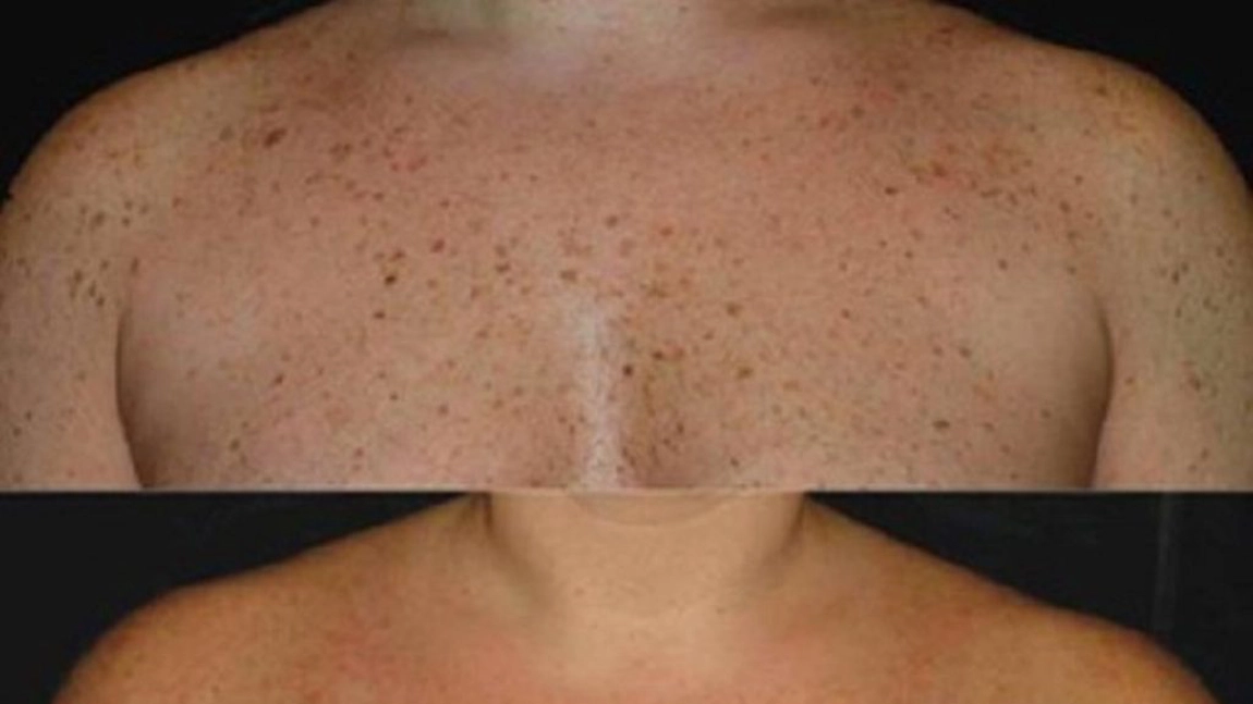 Cum să scapi de petele de pe piele