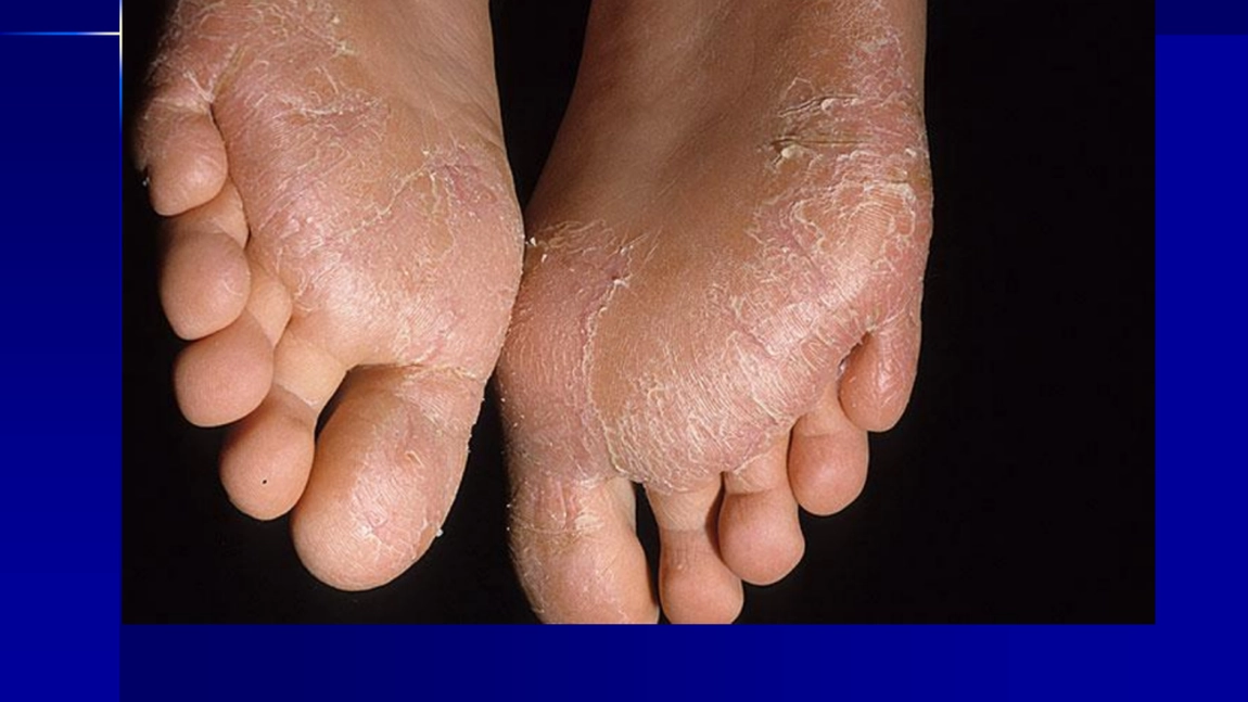 Sindromul Lyell: necroliză epidermică, o boala dermatologică foarte gravă generata de medicamente