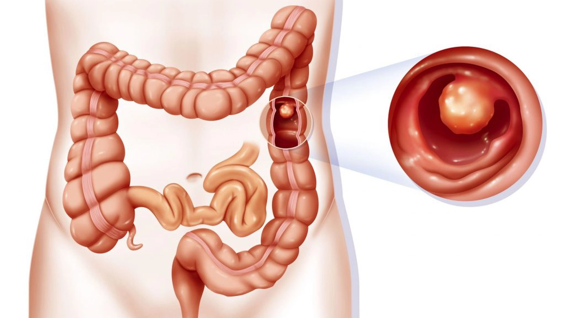 Polipii de colon, sursa de cancer. Cat de des trebuie facuta colonoscopia