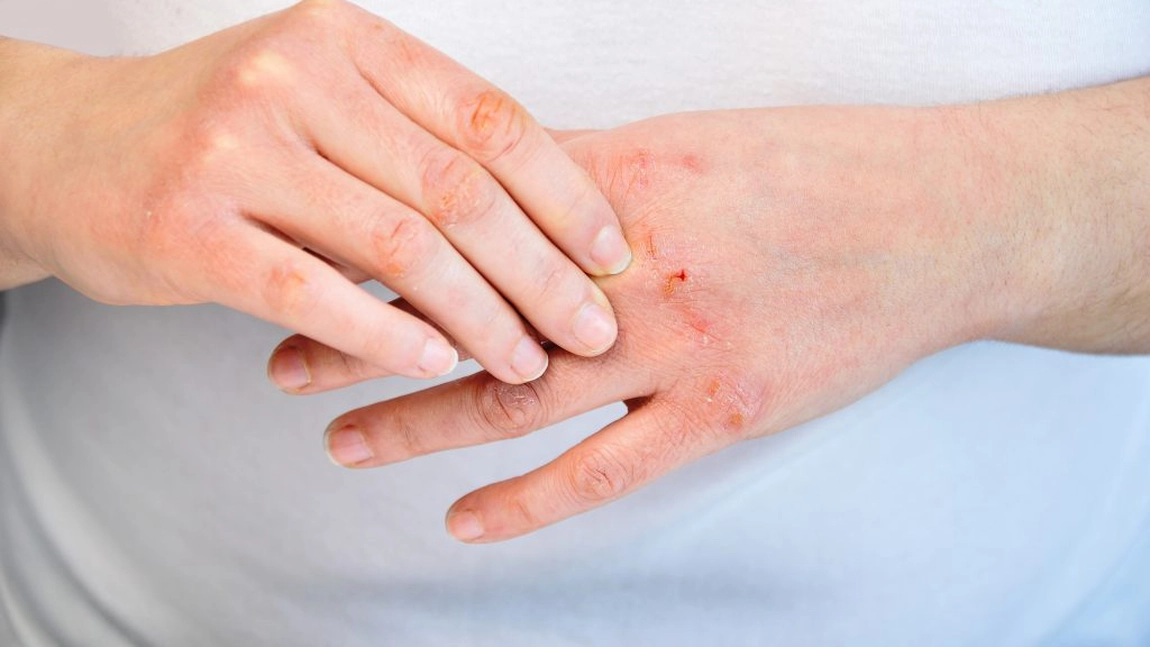 Alergia la latex. Aceste categorii de persoane sunt mai predispuse sa dezvolte afectiunea