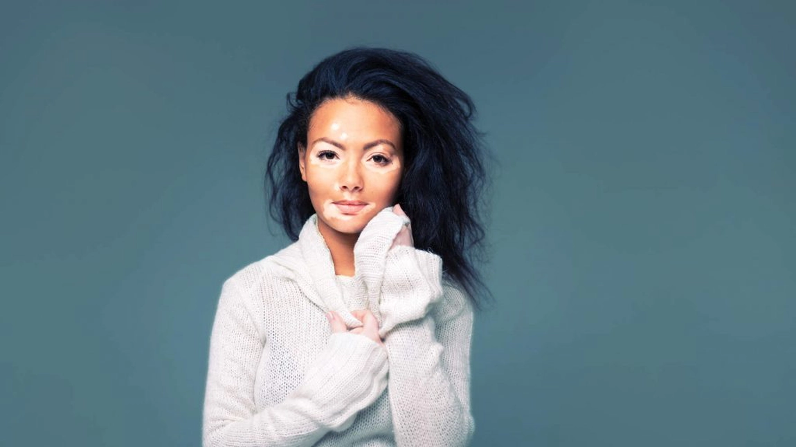 Vitiligo, provocat chiar de... vopseaua de par