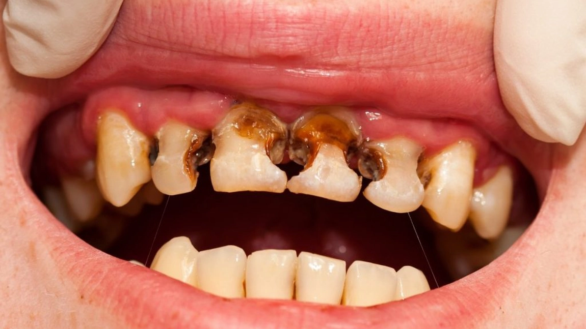 Carii: sistemul imunitar ar putea fi responsabil