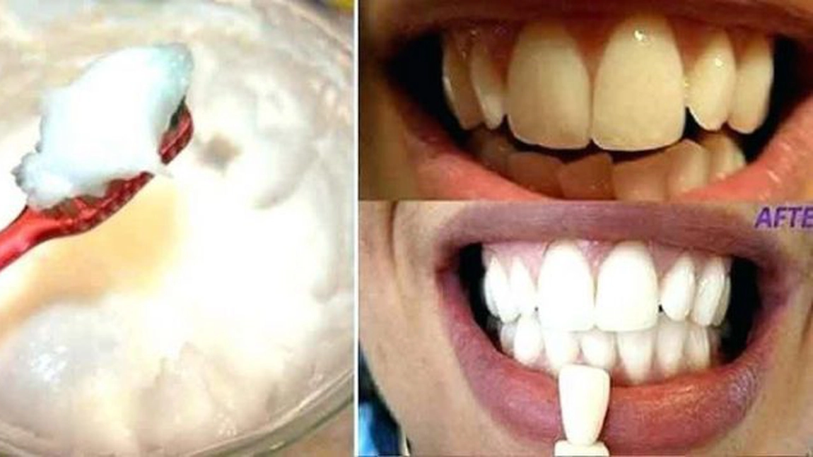 Remedii pentru albirea dinţilor în mod natural. 3 trucuri care le vor reda strălucirea