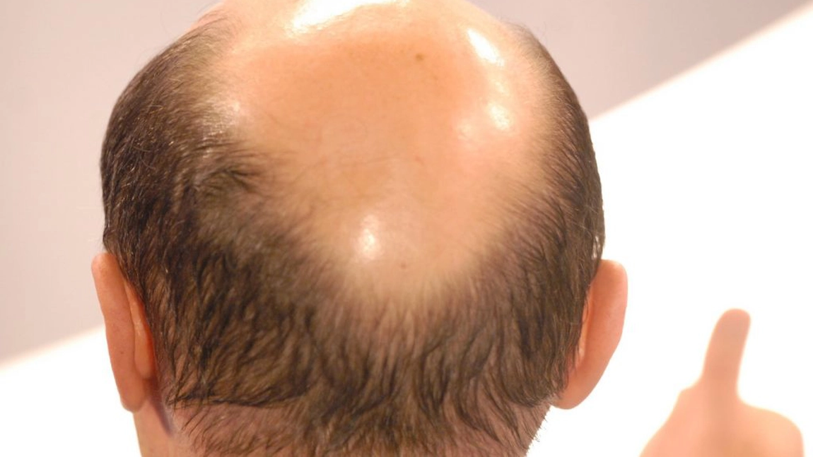 Medicamentul pentru căderea părului care provoaca probleme sexuale