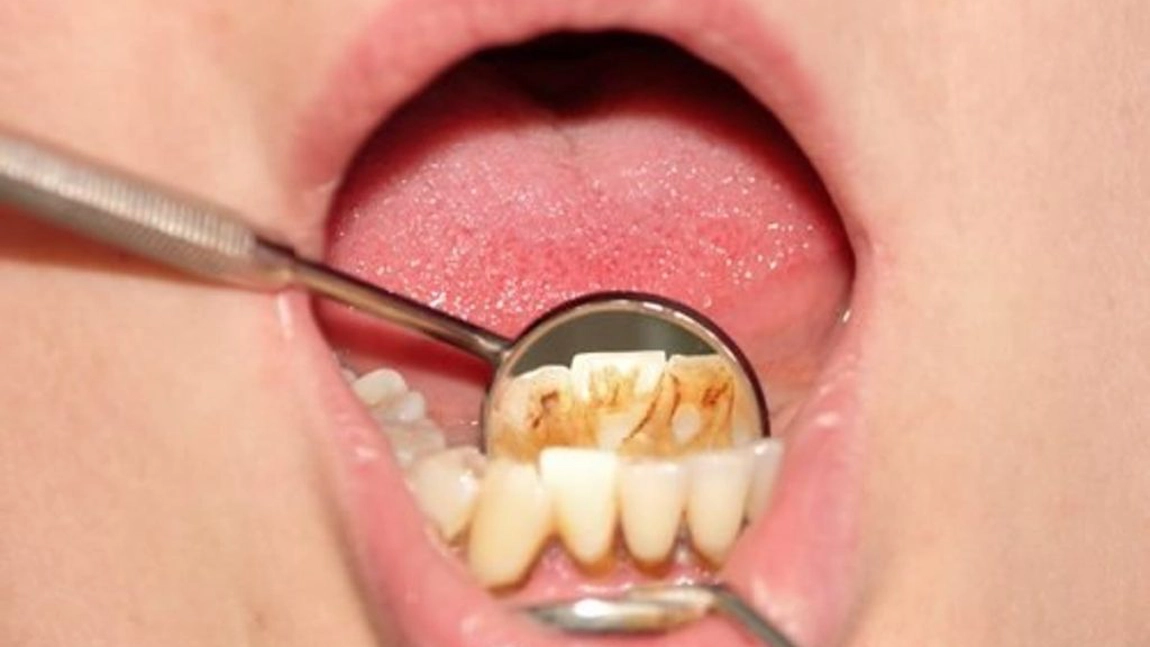 8 sfaturi pentru a elimina tartrul dentar în mod natural