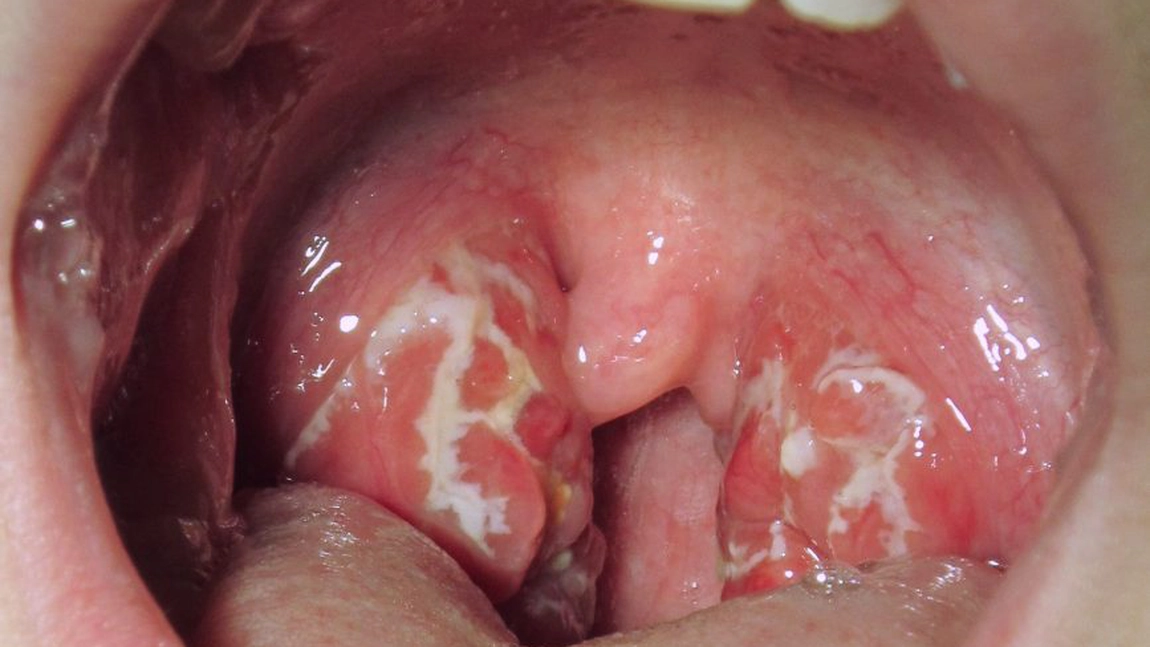 Cum sa faceți singuri bomboane pentru dureri în gât