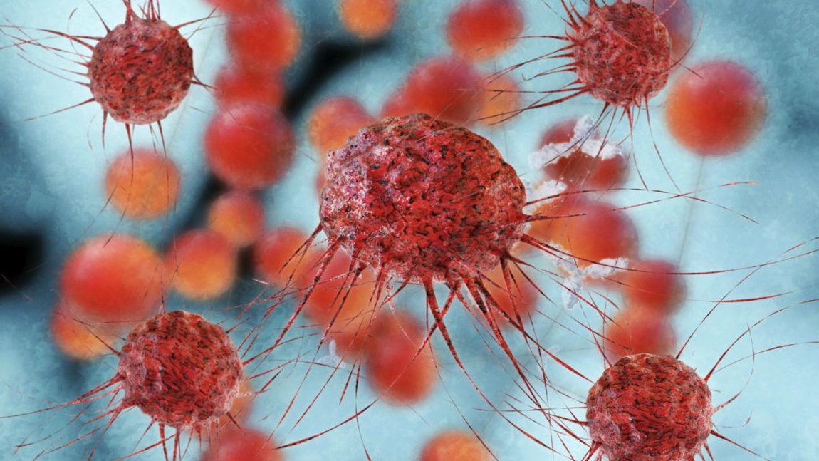 Semnele care anunta leucemia: care sunt persoanele cu risc