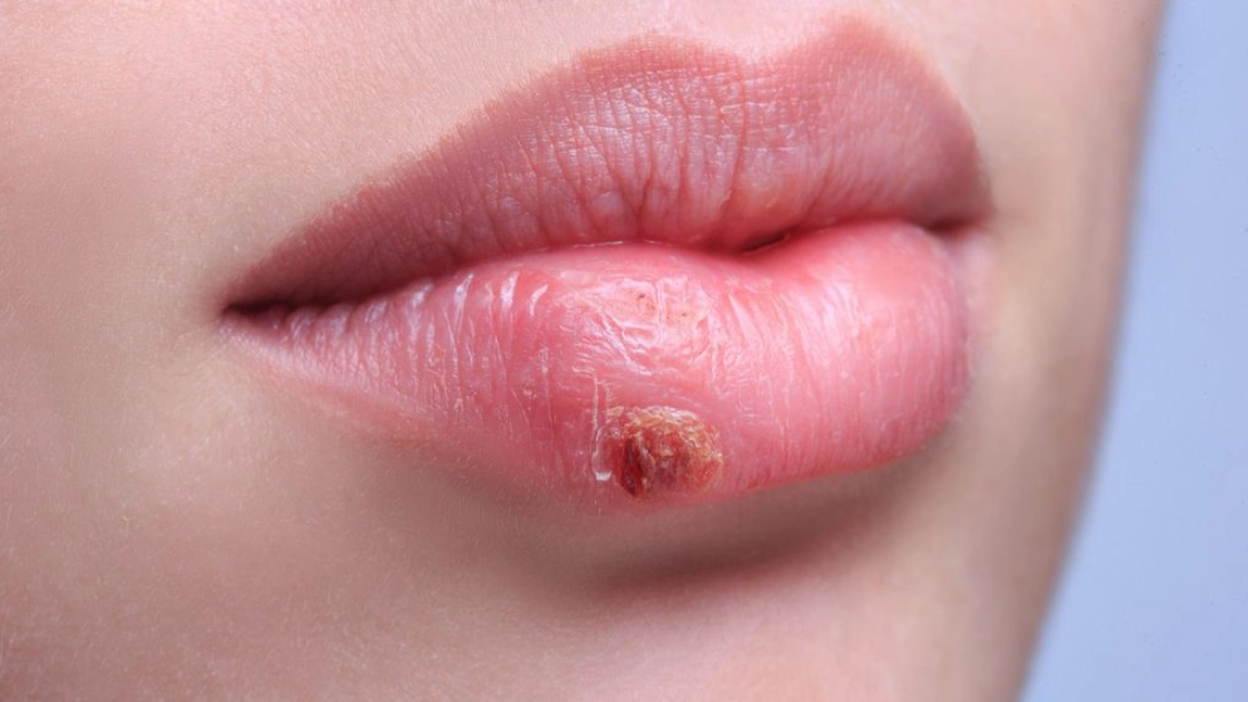 8 trucuri pentru a scăpa rapid de herpes