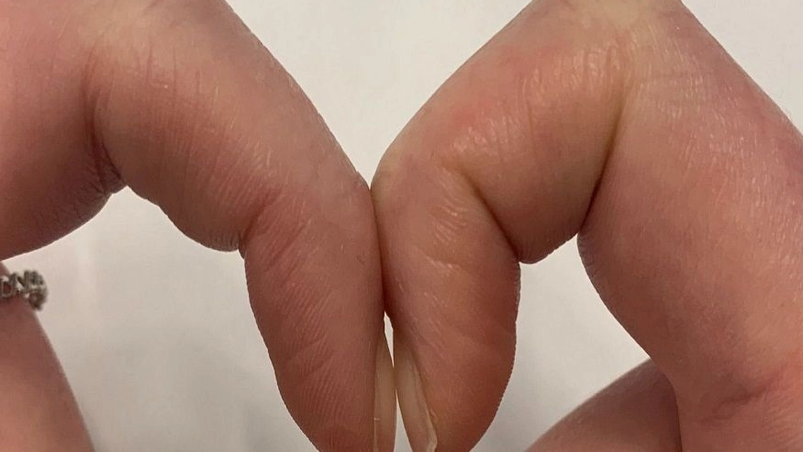 Testul banal care îți arată dacă ai cancer! Privește cu atenție dacă ai spațiul acesta între unghii. Îți poate salva viața!