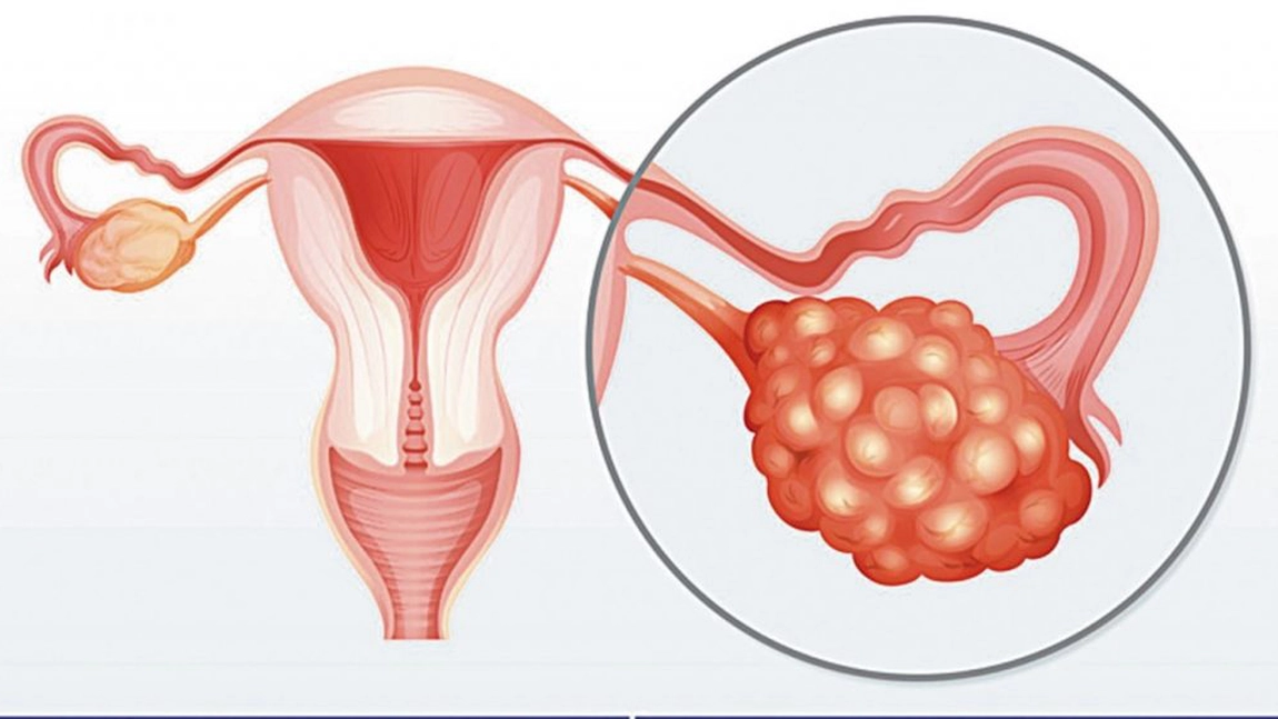 De ce femeile cu sindrom de ovare polichistice risca sa aiba o sanatatea precara pe toate planurile
