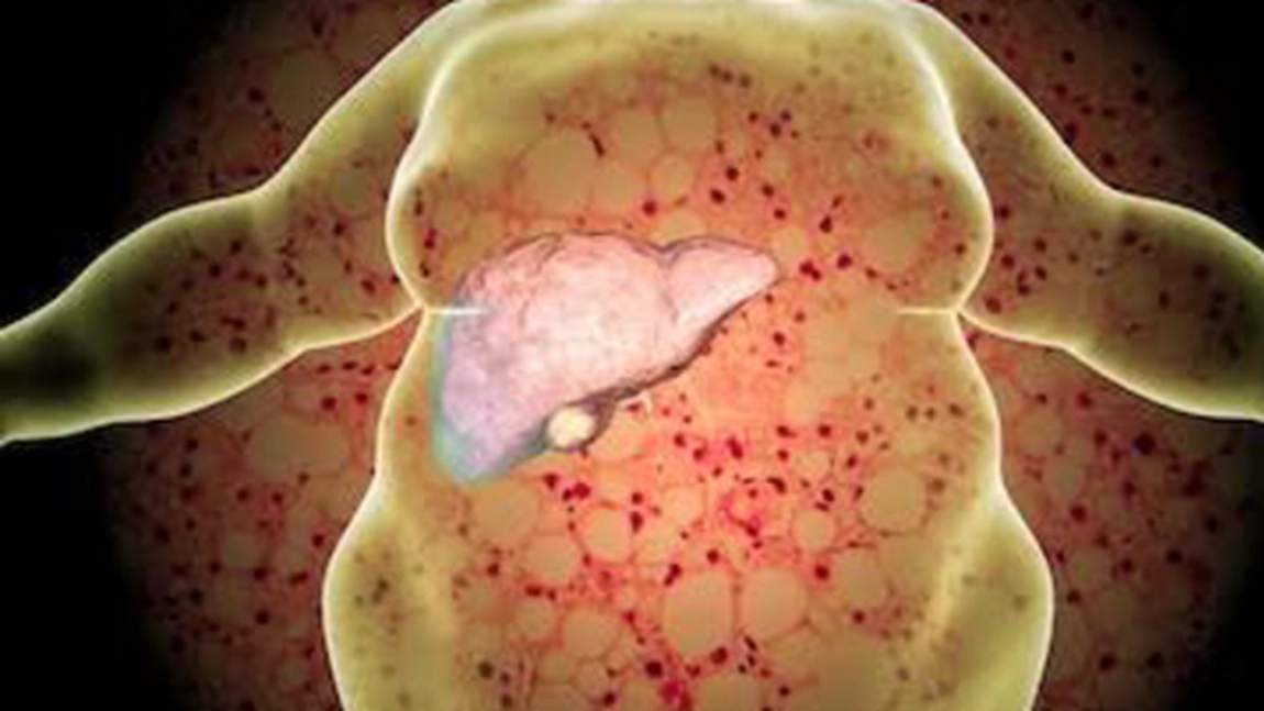 Antidotul ficatului gras! Este un remediu natural și eficient