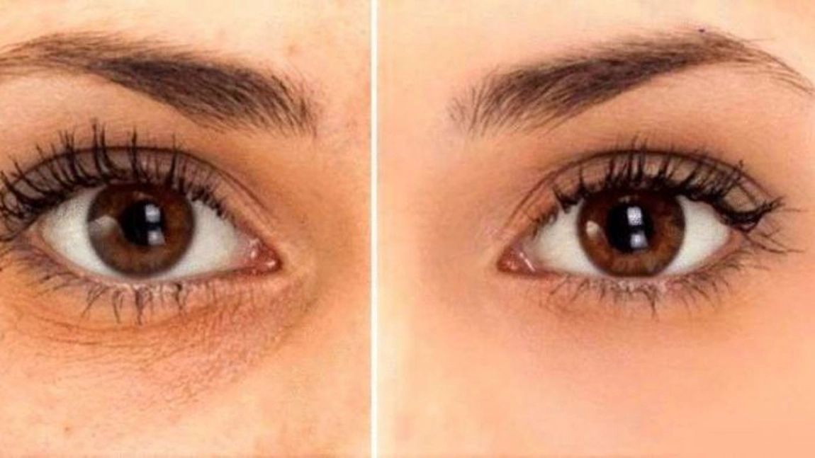 Cum poți înlătura cearcănele și pungile de sub ochi