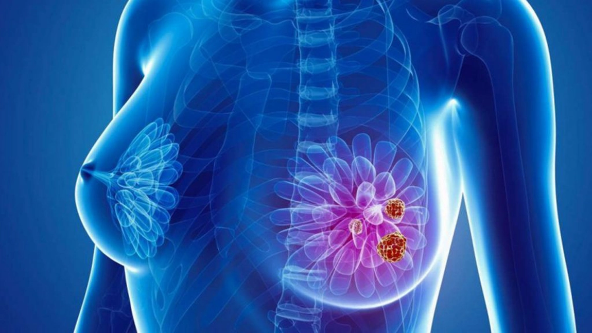 Cancer de sân, diagnosticat prin inteligență artificială oferita de Google