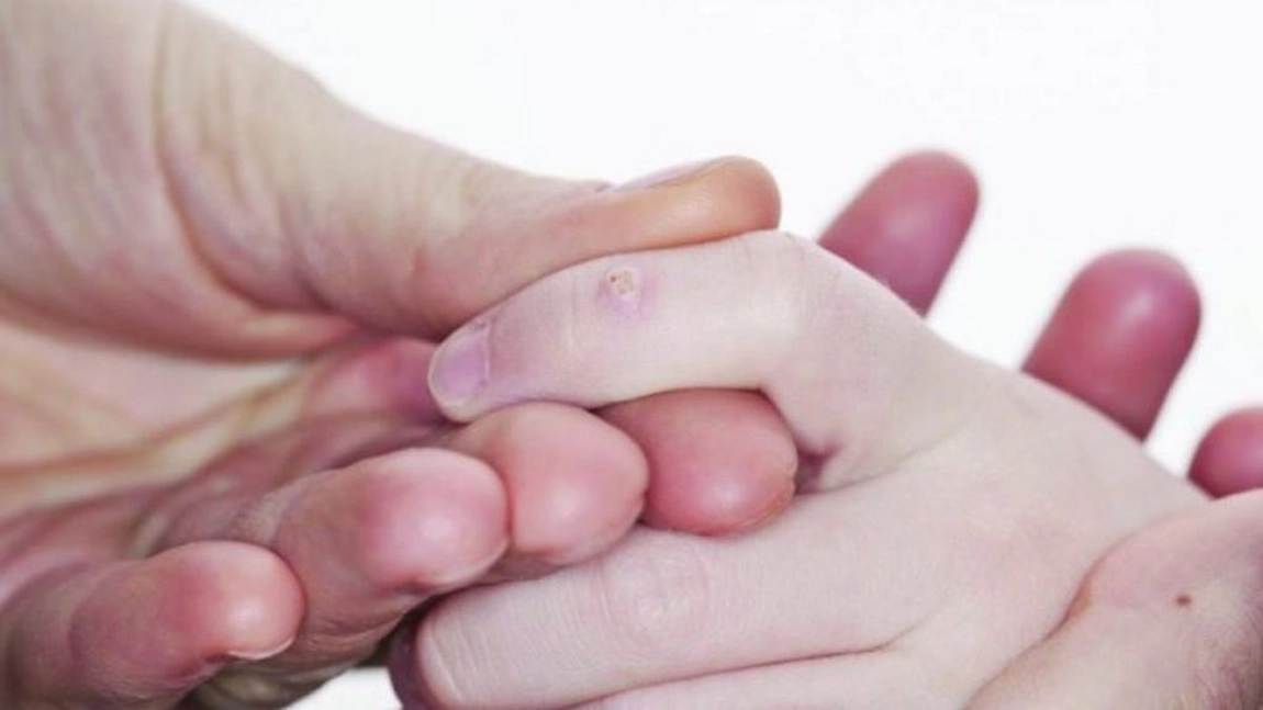 Cum să scapi de negi fără tratamente scumpe, la tine acasă