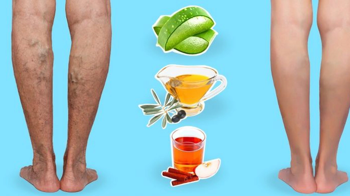 Şase remedii naturale care te ajută să vindeci varicele acasă