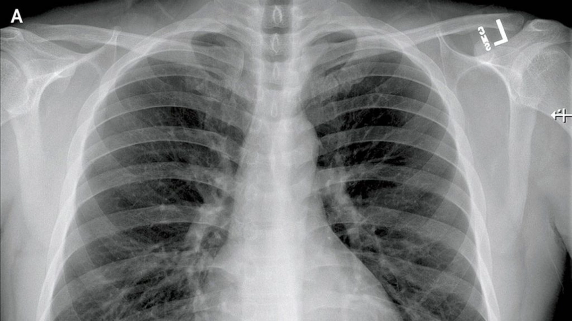 Autopsiile arata ca noul coronavirus distruge sistemul imunitar si ramane in trupurile celor decedati