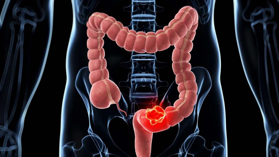 Veste buna pentru pacienti cu cancer colorectal