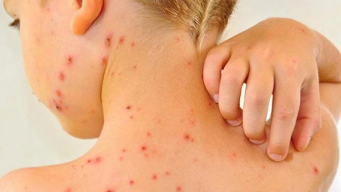 Noi cazuri de rujeolă la Iași! În întreaga țară s-au înregistrat peste 50! Medicii sunt precauți