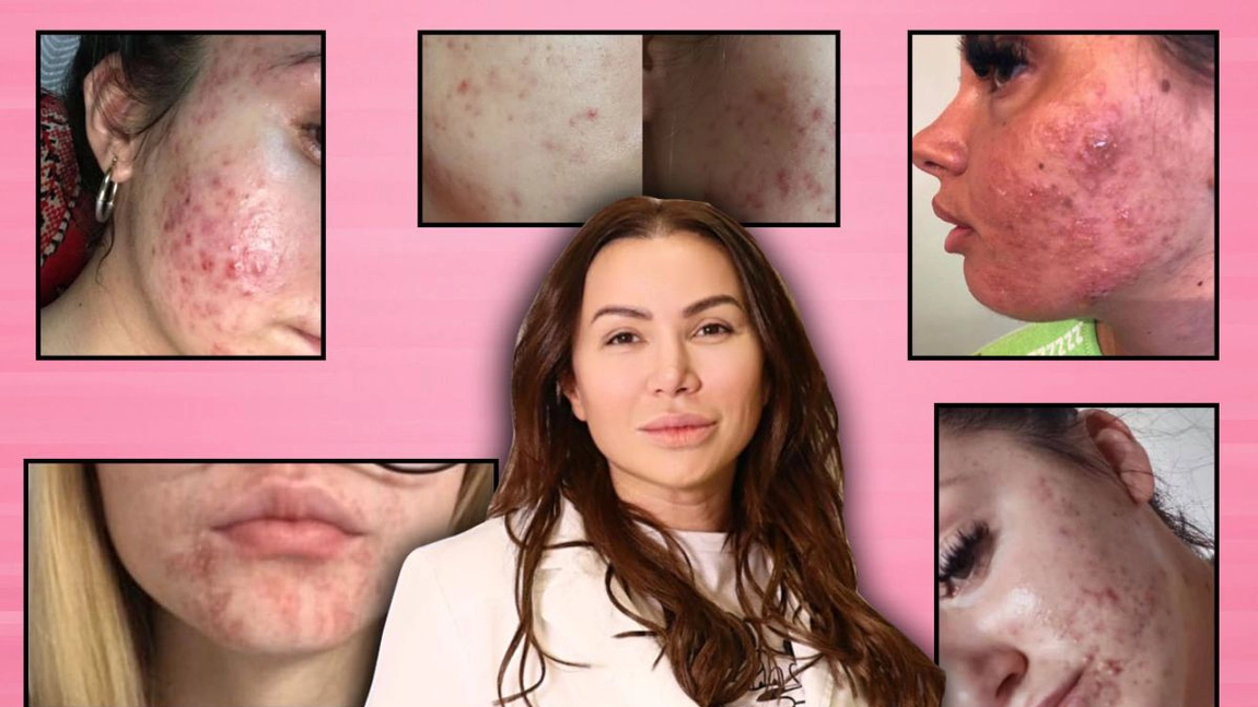 Acuzații grave! Zeci de persoane își strigă disperarea după ce tenul le-a fost distrus de un așa-zis dermatolog