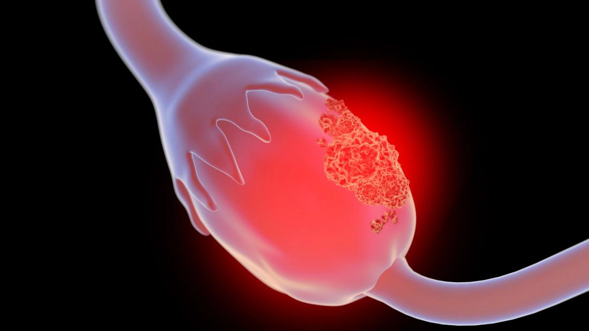 Simptomele cancerului ovarian: ascită, sângerari, dureri