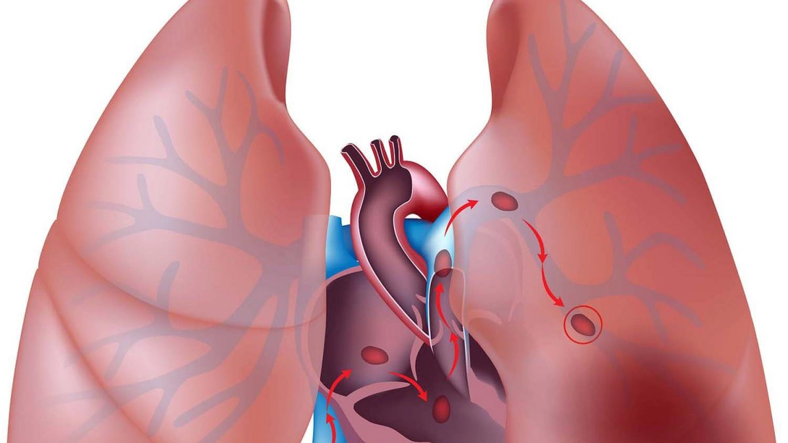 Ce este embolia pulmonară?