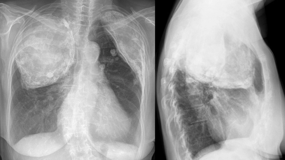 Vaccinul împotriva tuberculozei, un veritabil tratament pentru diabeticilor in varsta