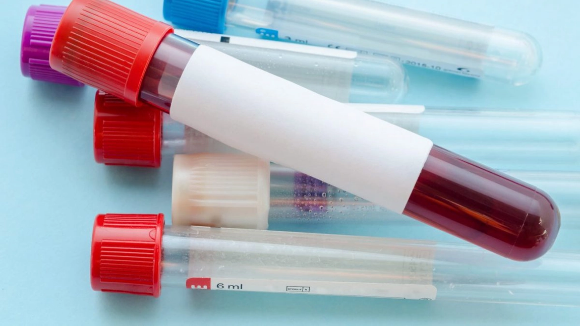 Cancer hepatic: un risc de zece ori mai mare la persoanele cu hemocromatoză