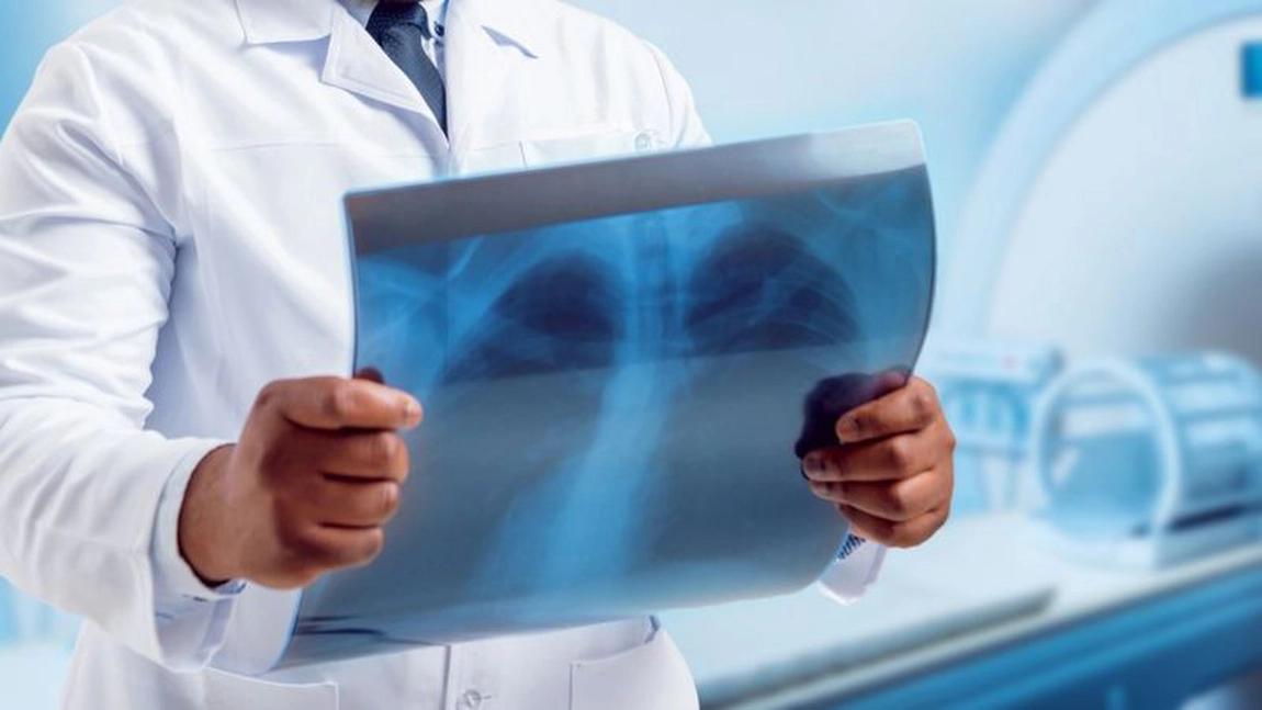 Infectarea cu COVID-19 provoacă leziuni pulmonare grave, arată un nou studiu