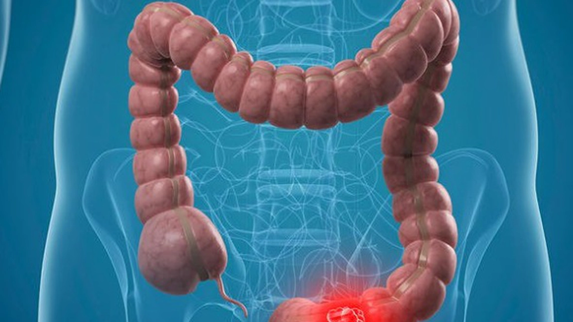 Cancerul colorectal la femei: 5 simptome îngrijorătoare