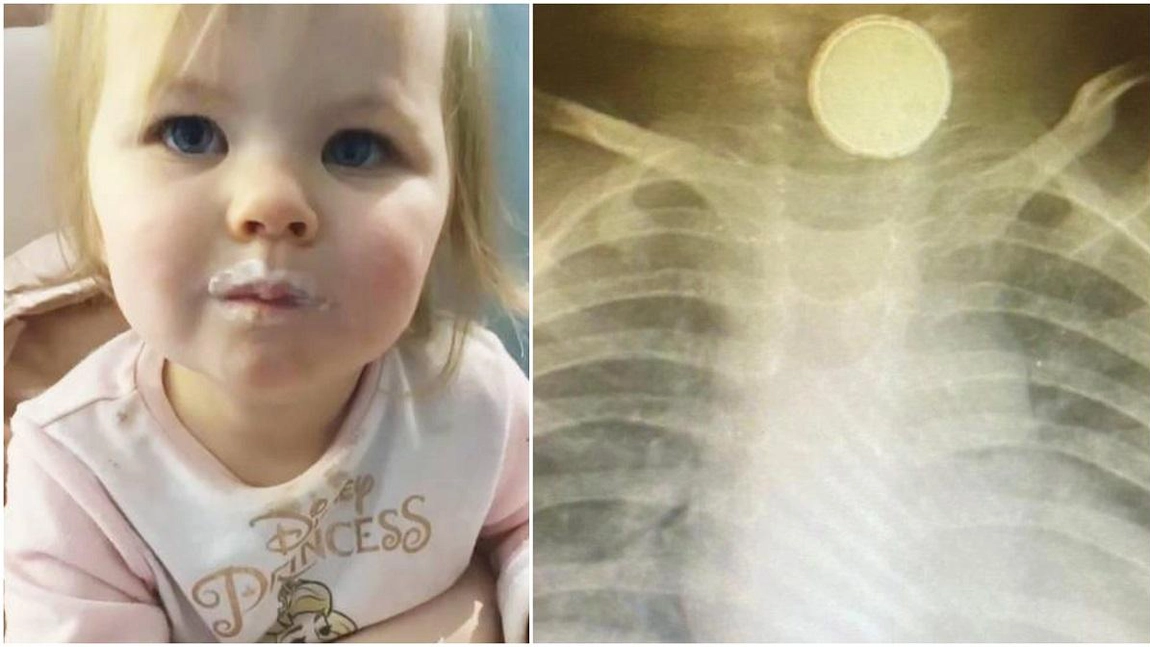 Un bebeluş a stat 4 luni cu baterie în gât. Medicii au crezut că are amigdalită