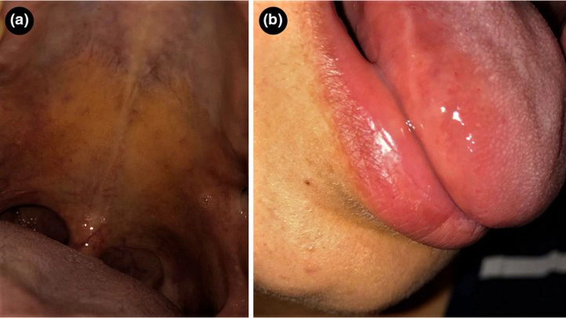 Un nou simptom arată dacă ești infectat: „Limba COVID“, simptom depistat de medicii spanioli