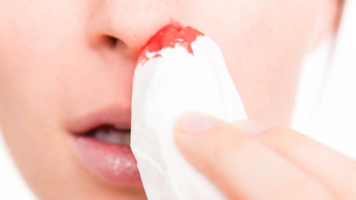 Sângerare nazală: metode să oprești rapid un epistaxis