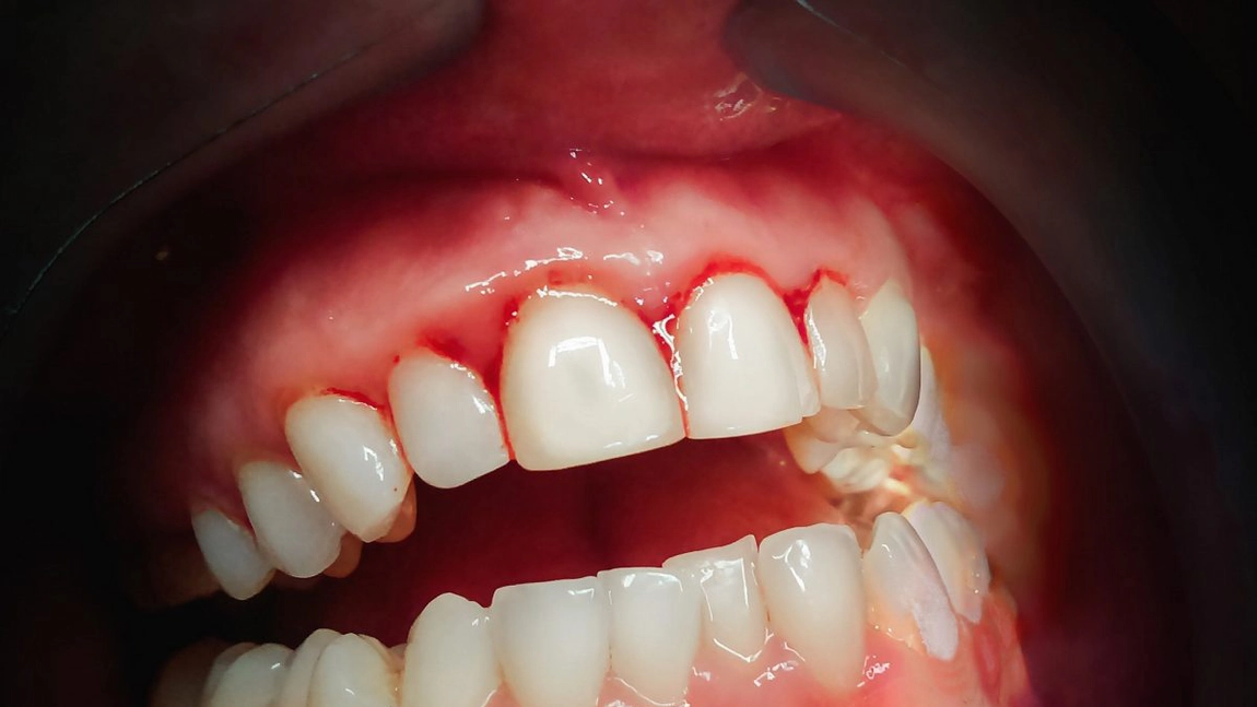 Vă sângerează gingiile? Folosiți vitamina C!