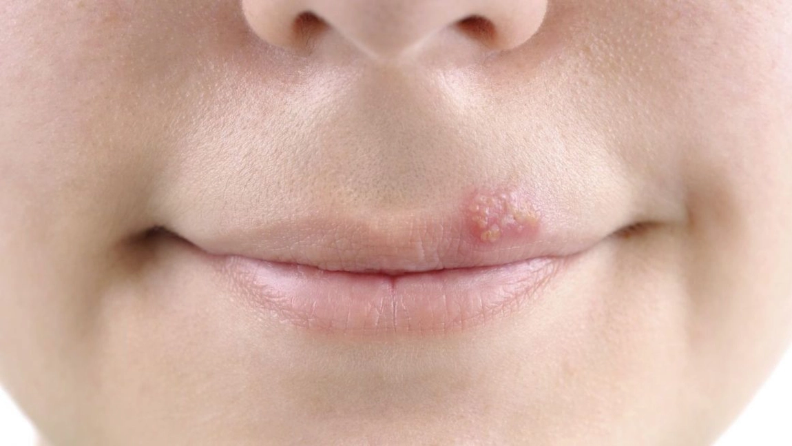Herpes: 4 soluții naturale pentru vindecare