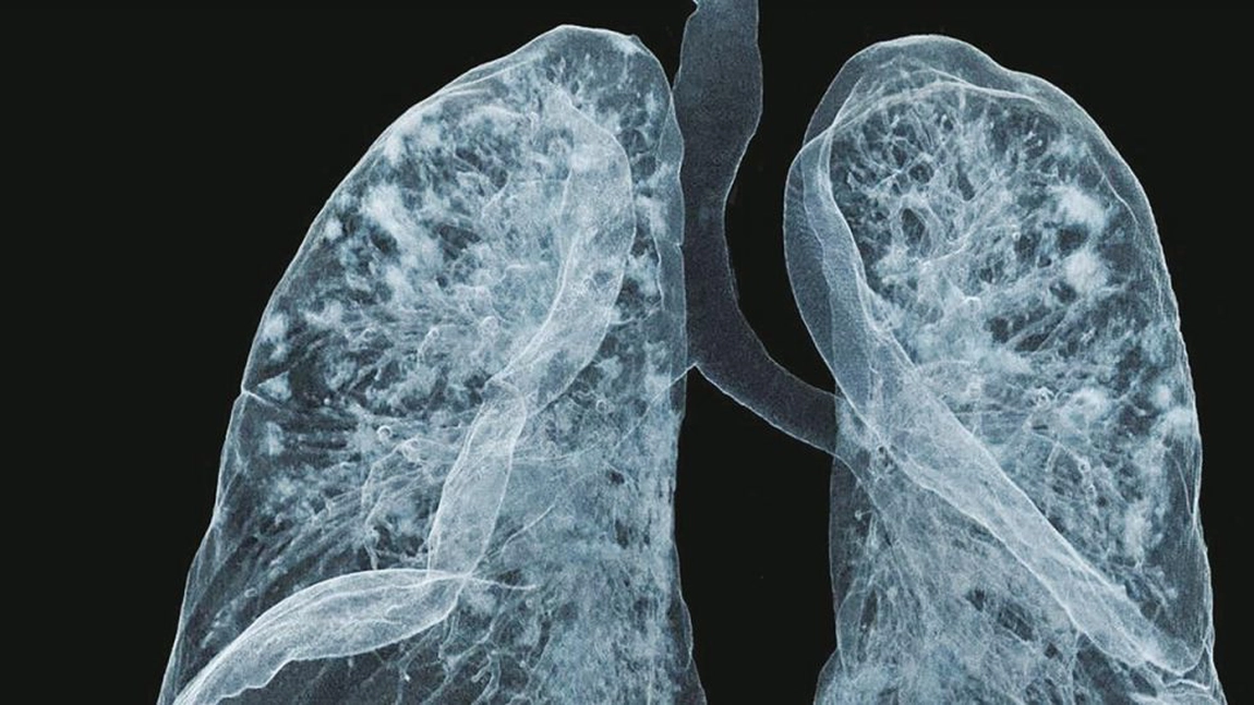 Covid lung: asimptomatici în momentul infecției, acești pacienți suferă de sechele întârziate
