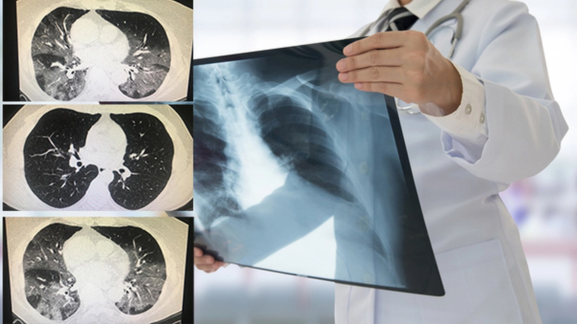 Pacienții post-COVID-19 ajung la UPU cu suprainfecție pulmonară după câteva săptămâni de la externare! Locurile din spitalele ieșene pentru tratarea acestor bolnavi sunt insuficiente