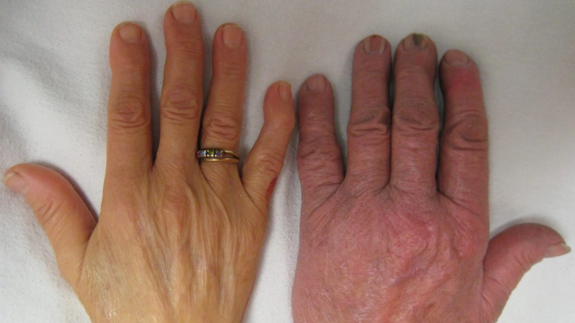 Hemoglobina scazuta: 10 simptome care arata ca aveti anemie