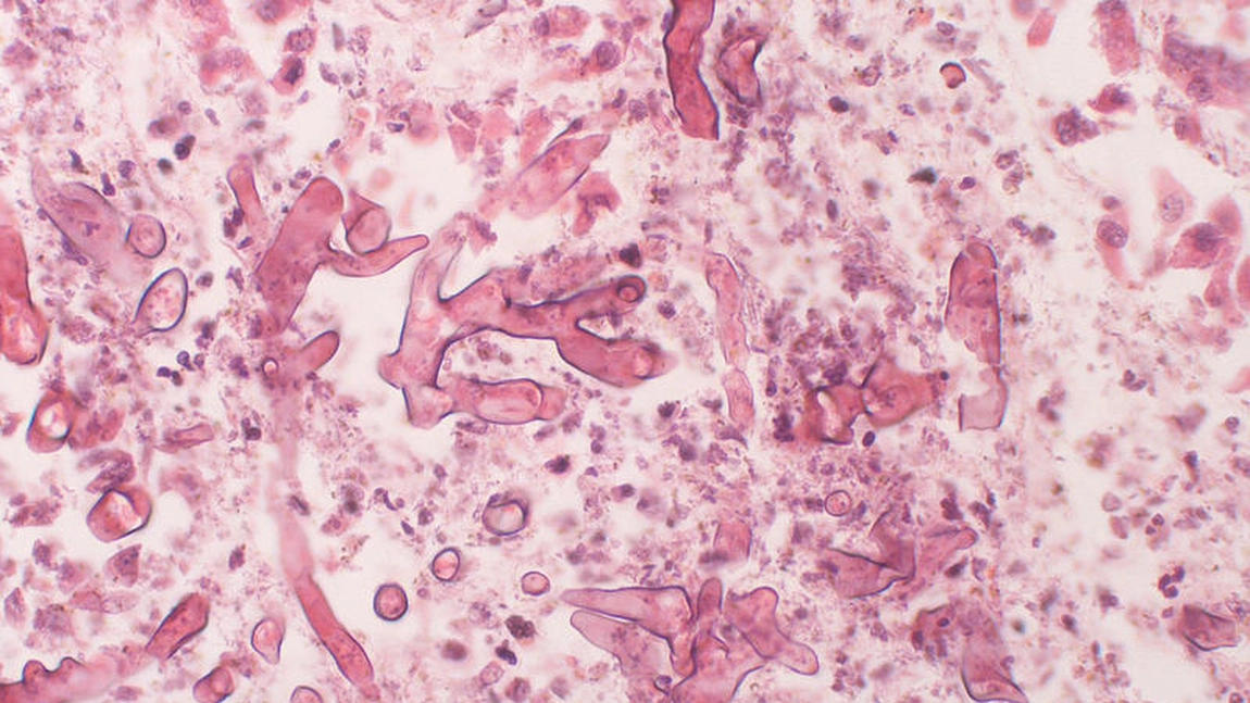Mucormicoza, afecțiunea care face ravagii în rândul pacienților infectați cu noul coronavirus. Cât de contagioasă este
