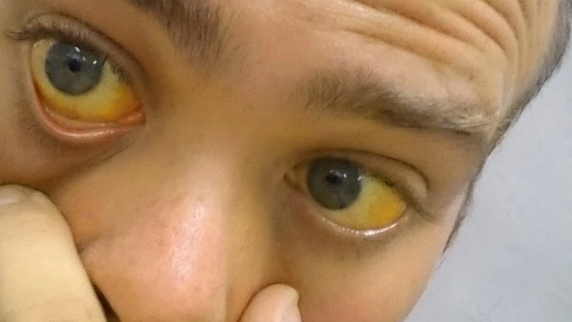 Albul ochilor, îngălbenit: Când se întâmplă asta și când ar trebui să mergi la medic