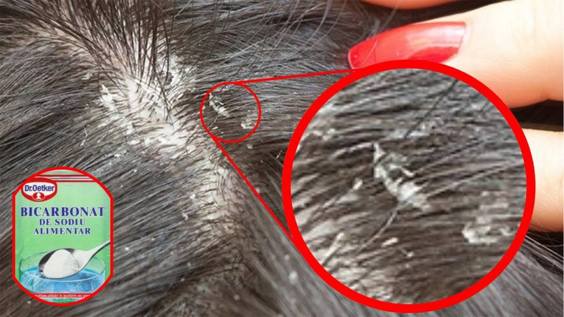 Bicarbonat de sodiu împotriva păduchilor: Are efecte uimitoare în lupta cu pediculoza