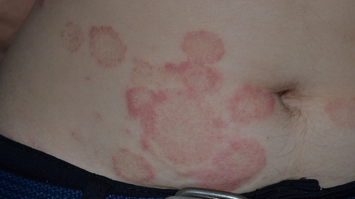 Herpes circinat: Care sunt simptomele și cum se tratează