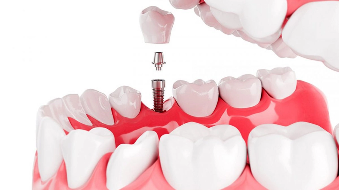 Avantajele implantului dentar. De ce ar trebui să alegi tratamentul cu implanturi dentare?
