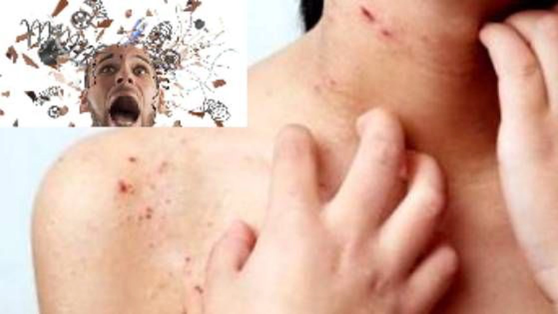 Alergii ale pielii pe sistem nervos: Cât de tare vă afectează stresul