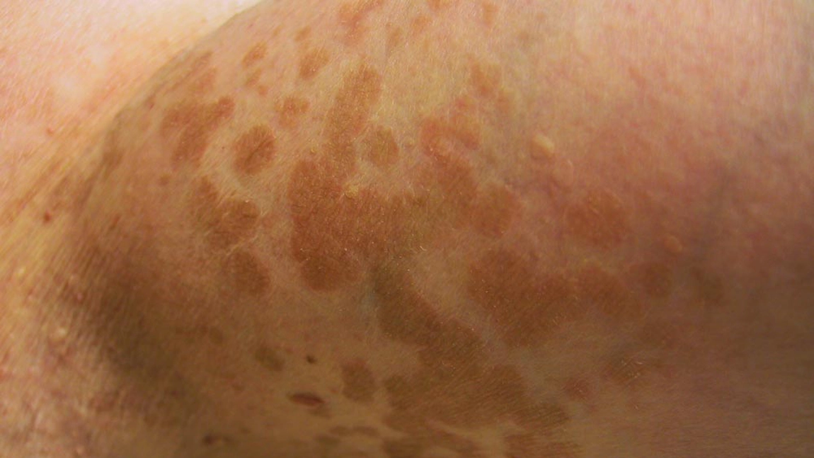 Pitiriazis versicolor: Cauze, simptome, tratament naturist