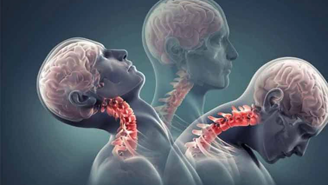 Tratament pentru spondiloza cervicală: Ce să faci dacă te confrunți cu amețeli