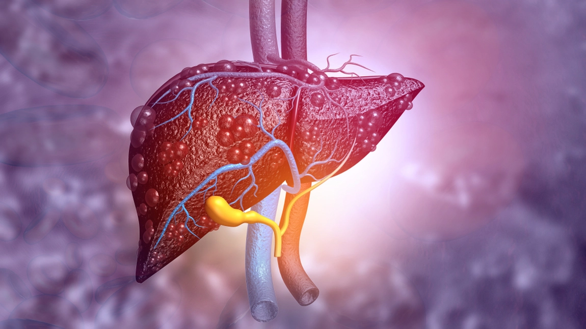Steatoza hepatică alcoolică: Ce este, cum se manifestă și cum poate fi tratată