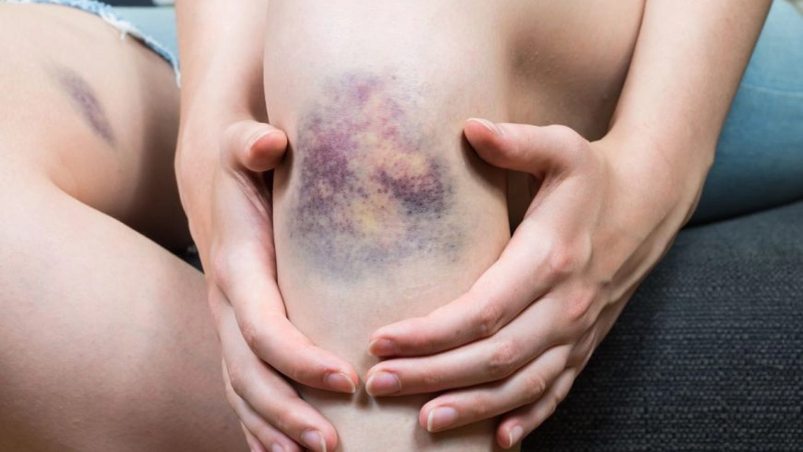 Purpura trombocitopenică autoimună: Ce este, simptome și tratament