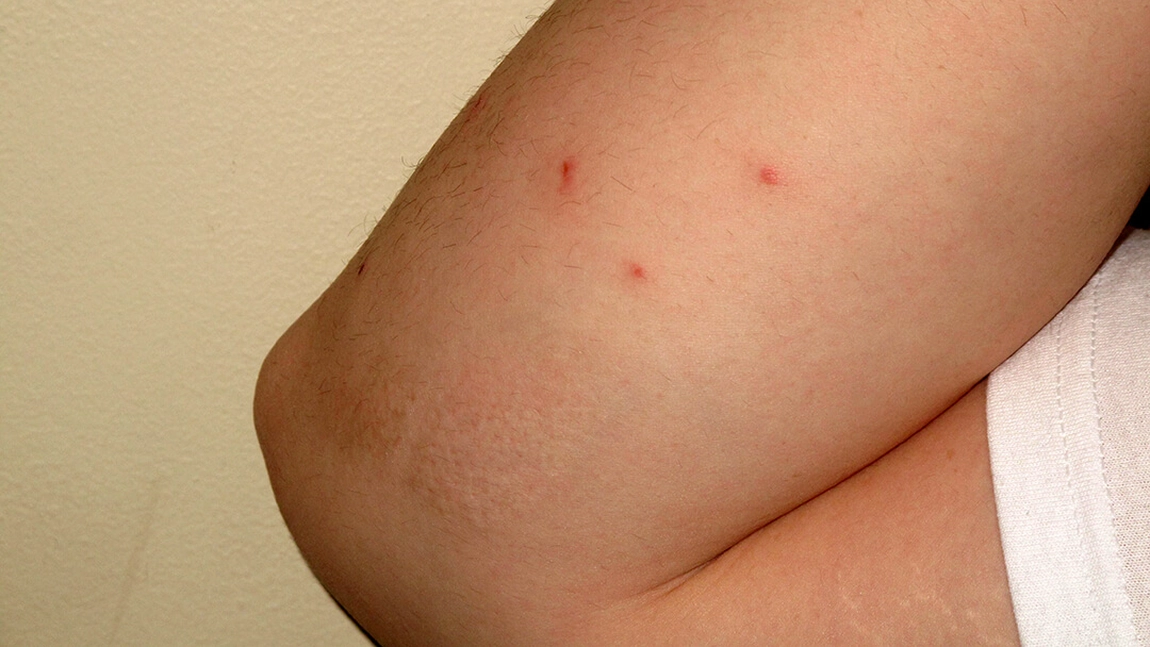 Poze cu mușcături de insecte: Cum să acorzi primul ajutor și când trebuie să consulți un medic